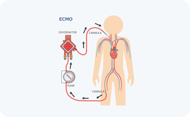 ECMO